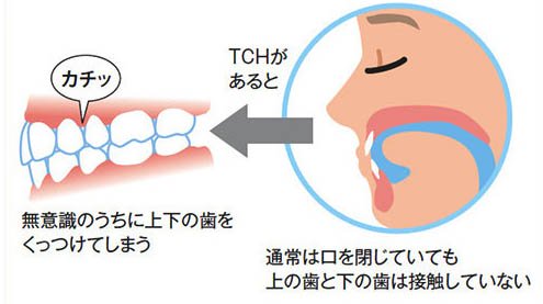 歯列接触癖